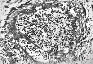poxvirus - molluscum contagiosum poxvirus - molluscum contagiosum